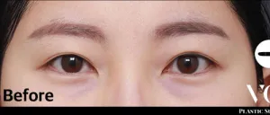 Before
