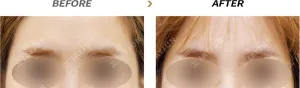 Before
