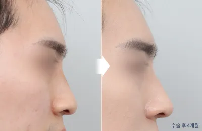 Before & After