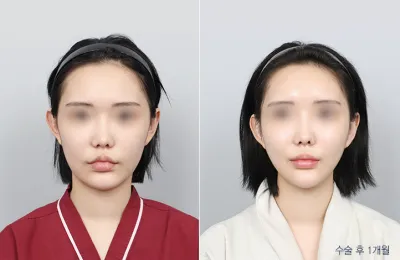 Before & After