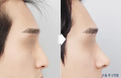 Before & After