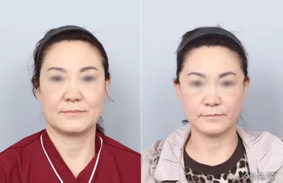 Before & After