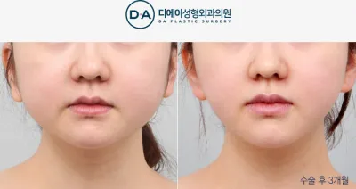 Before & After