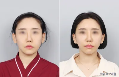 Before & After