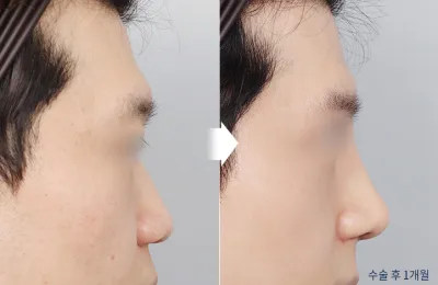 Before & After
