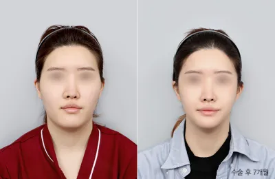 Before & After