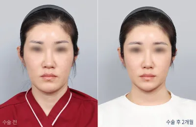 Before & After