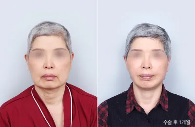 Before & After
