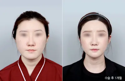 Before & After