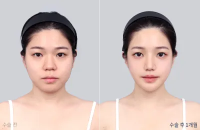 Before & After