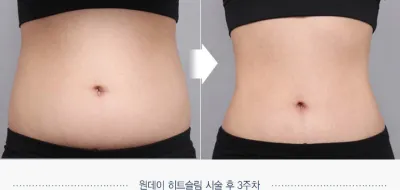 Before & After