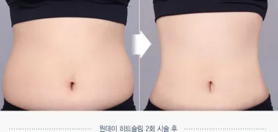 Before & After