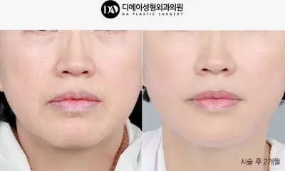 Before & After