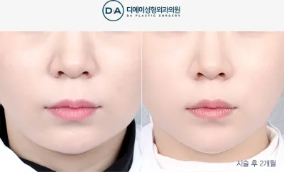 Before & After