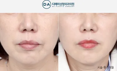 Before & After