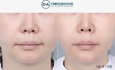 Before & After