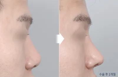 Before & After