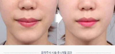 Before & After