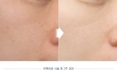 Before & After