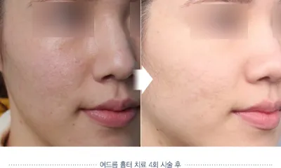 Before & After