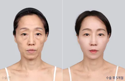 Before & After