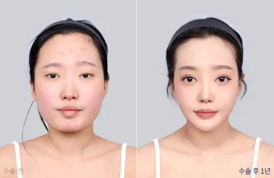 Before & After