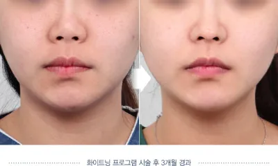 Before & After