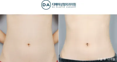 Before & After