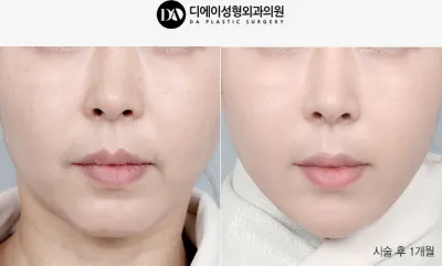 Before & After