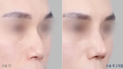 Before & After