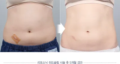 Before & After