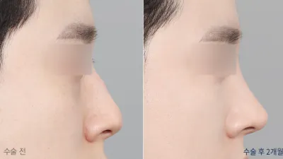 Before & After