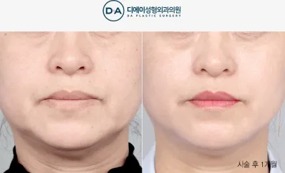 Before & After