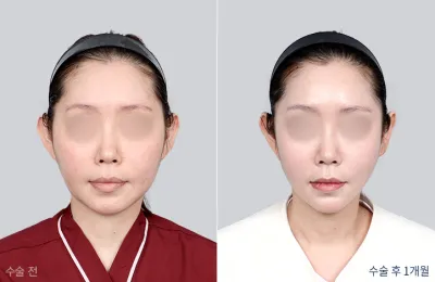 Before & After