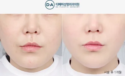 Before & After