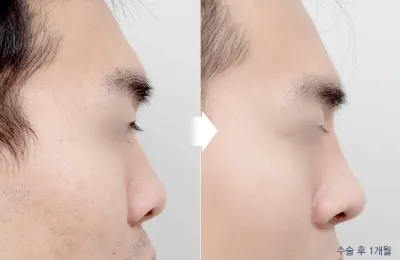 Before & After