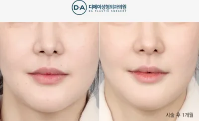 Before & After