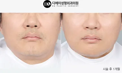 Before & After