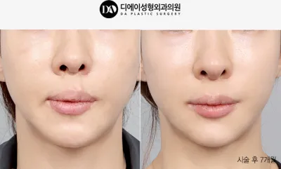 Before & After