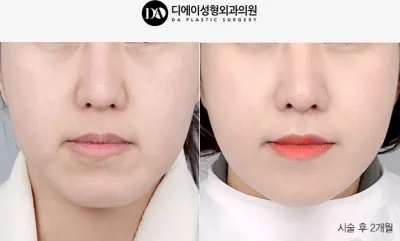 Before & After