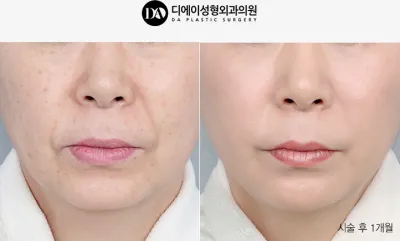 Before & After