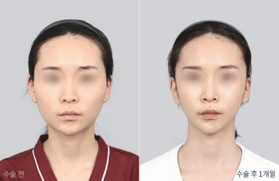 Before & After