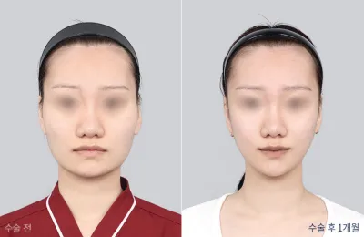Before & After