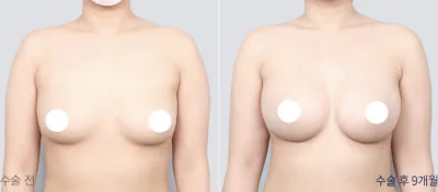 Before & After