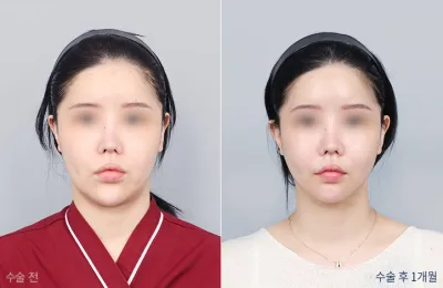 Before & After