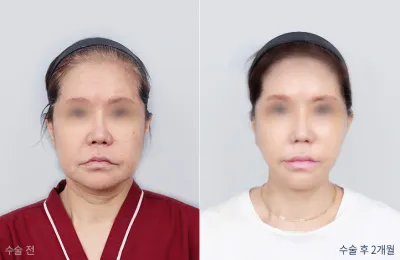 Before & After
