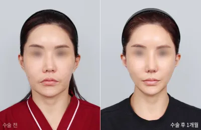 Before & After