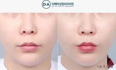 Before & After