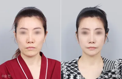 Before & After