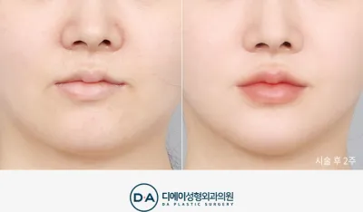 Before & After
